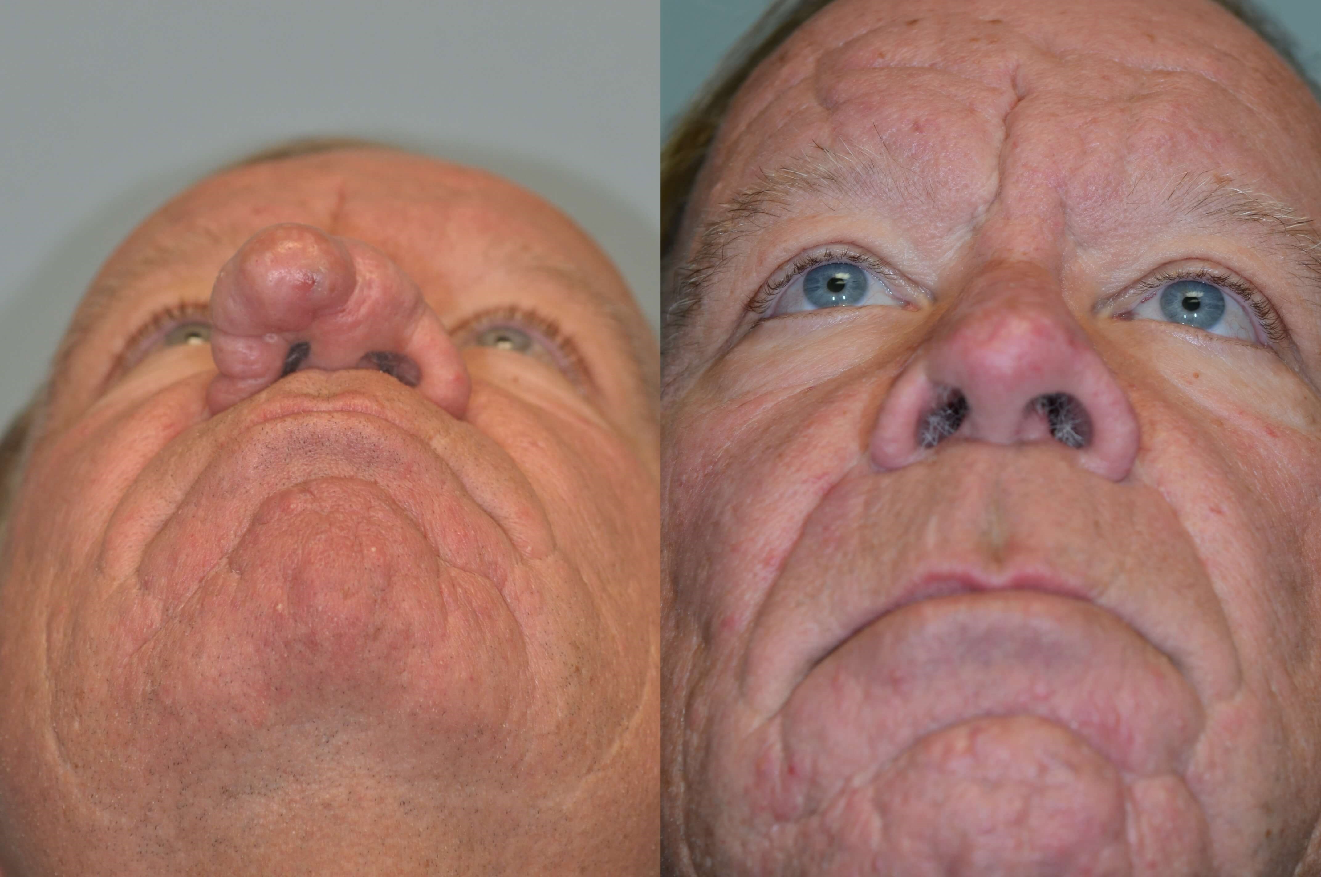 Rhinophyma Before and After
