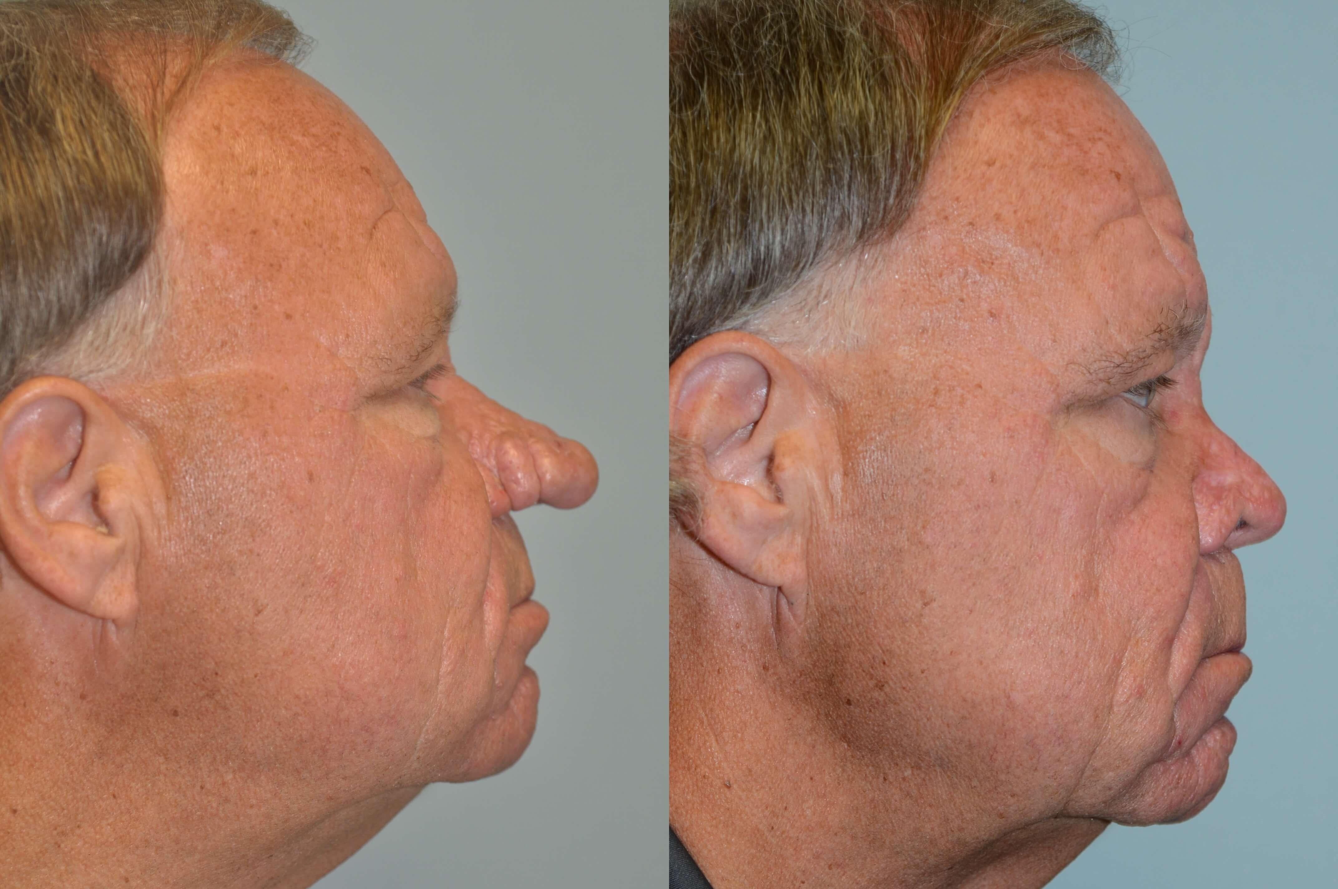 Rhinophyma Before and After