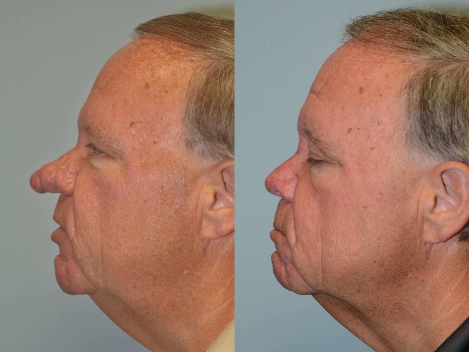 Nasal Reconstruction by Excision of Rhinophyma