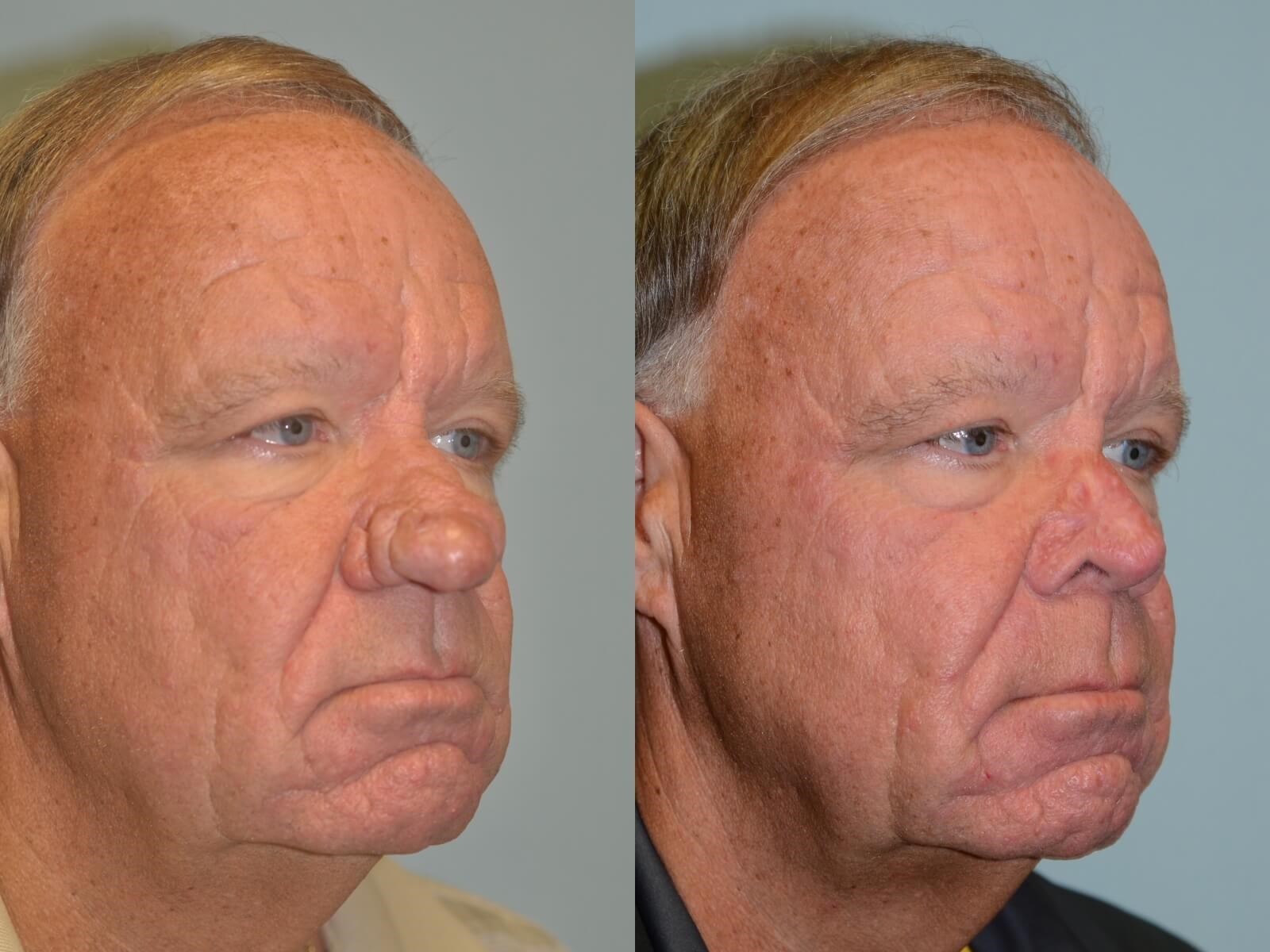 Rhinophyma Before and After