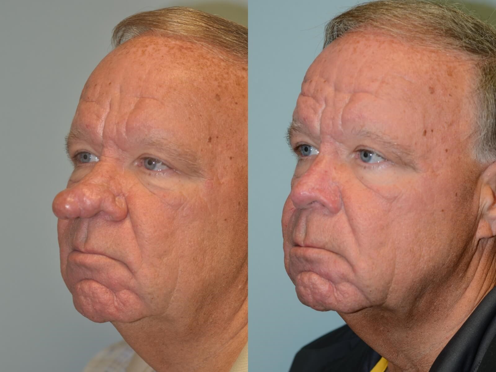 Nasal Reconstruction by Excision of Rhinophyma