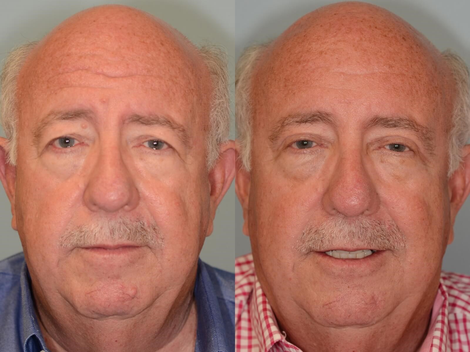 Endoscopic Brow lift Before and After