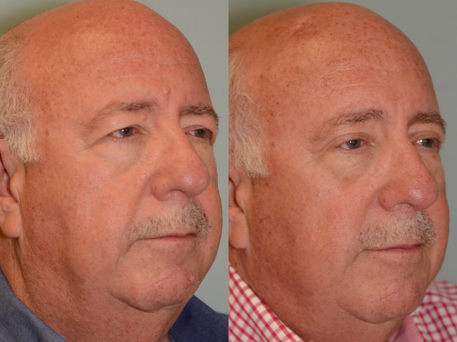 Brow lift and Upper Eyelid Before and After