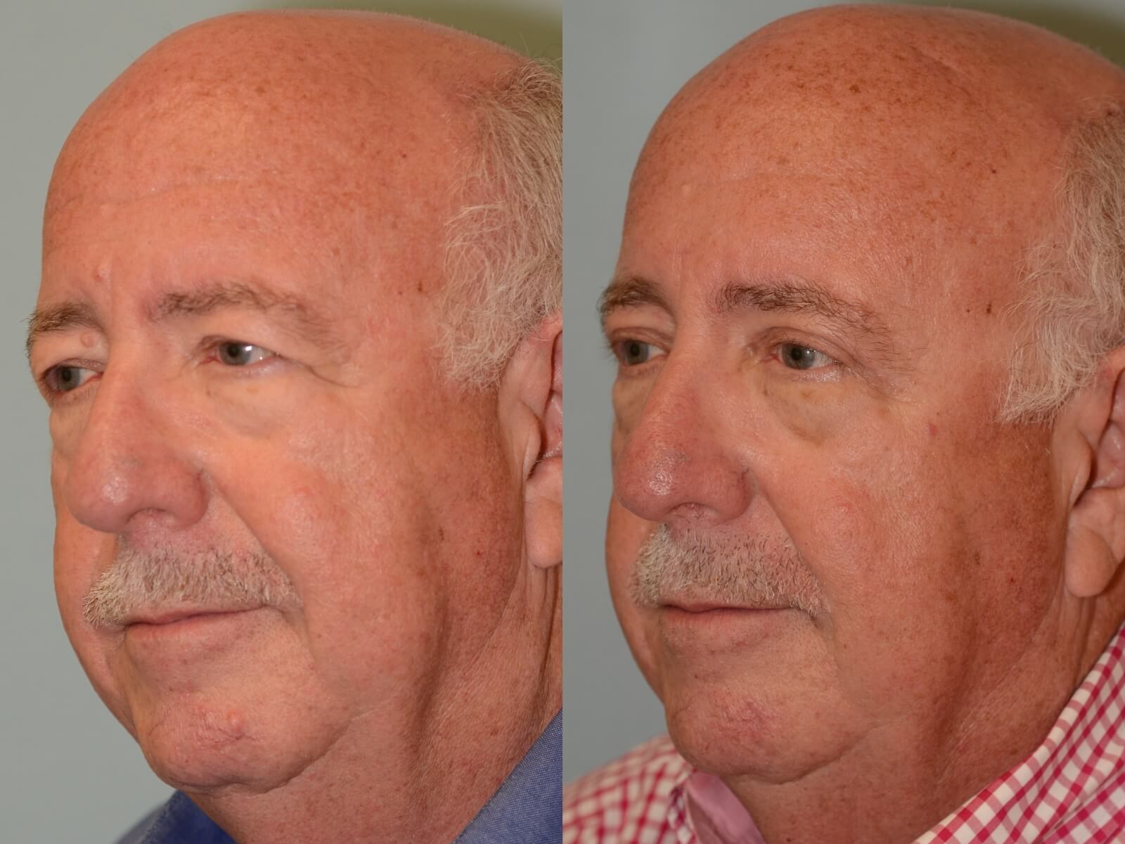 Brow lift and Upper Eyelid Before and After