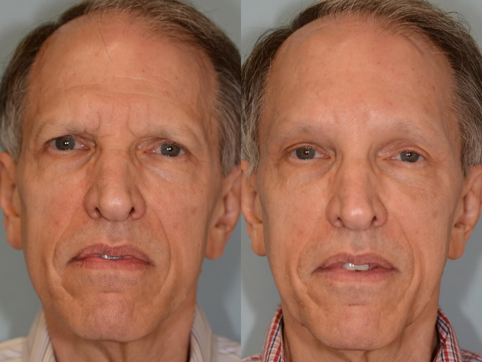 Endoscopic Brow lift Before and After
