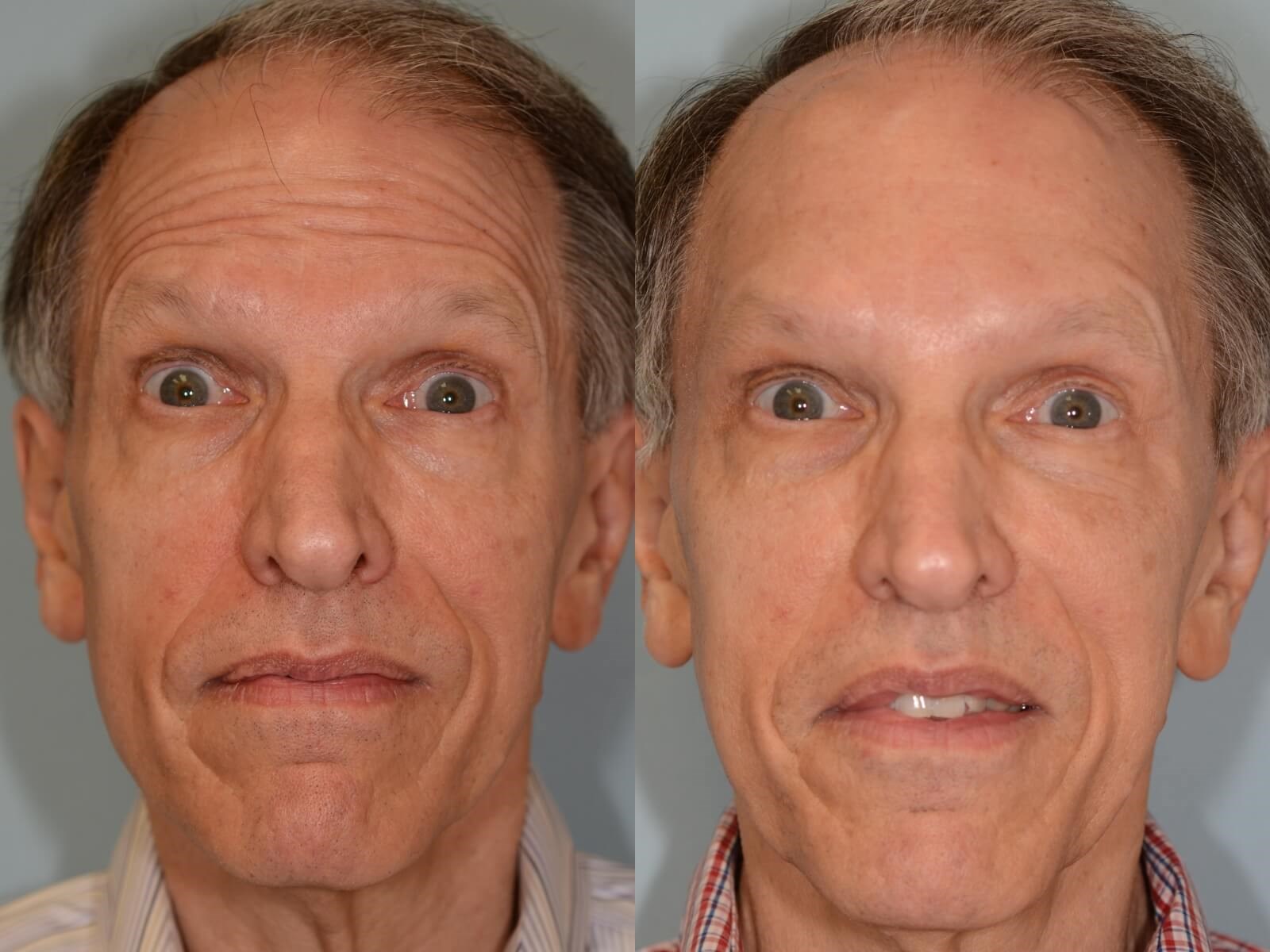 Endoscopic Brow lift Before and After