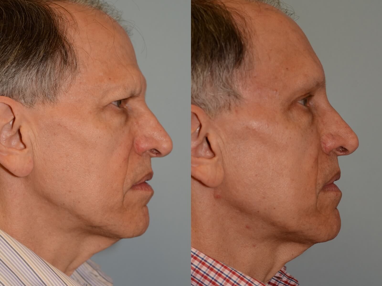 Endoscopic Brow lift Before and After