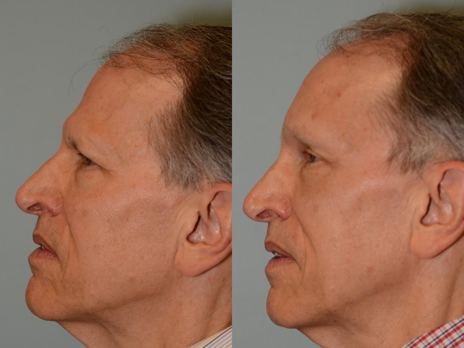 Endoscopic Brow lift Before and After