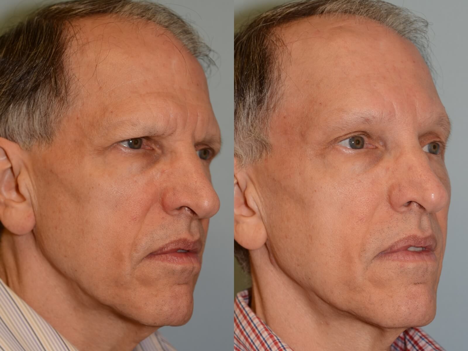 Endoscopic Brow lift Before and After