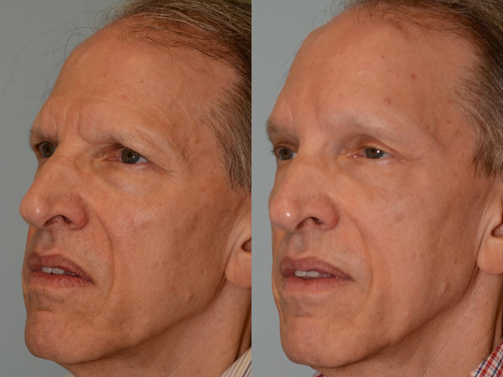 Endoscopic Brow lift Before and After