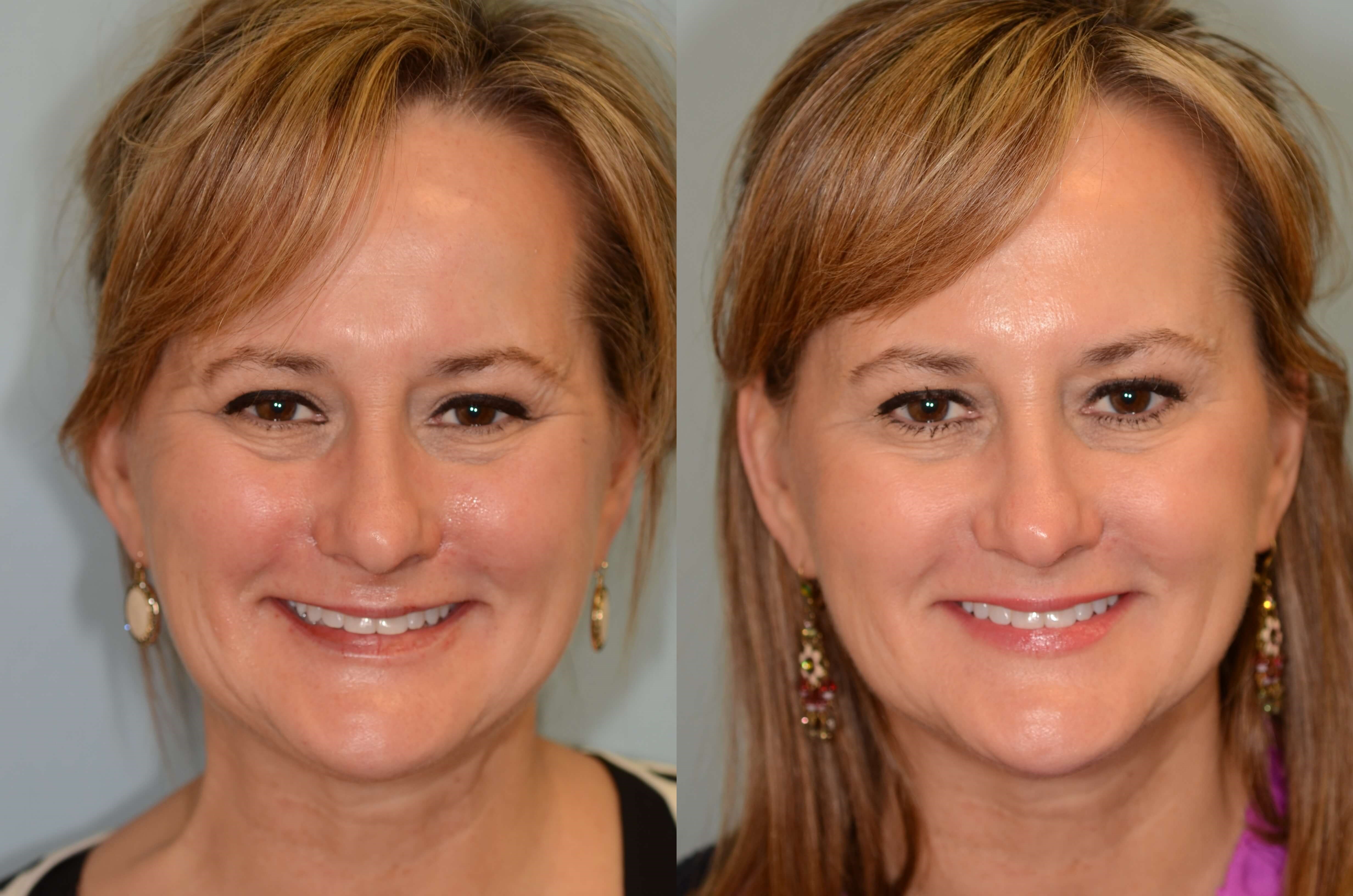 Botox to smooth away wrinkles! Before and After