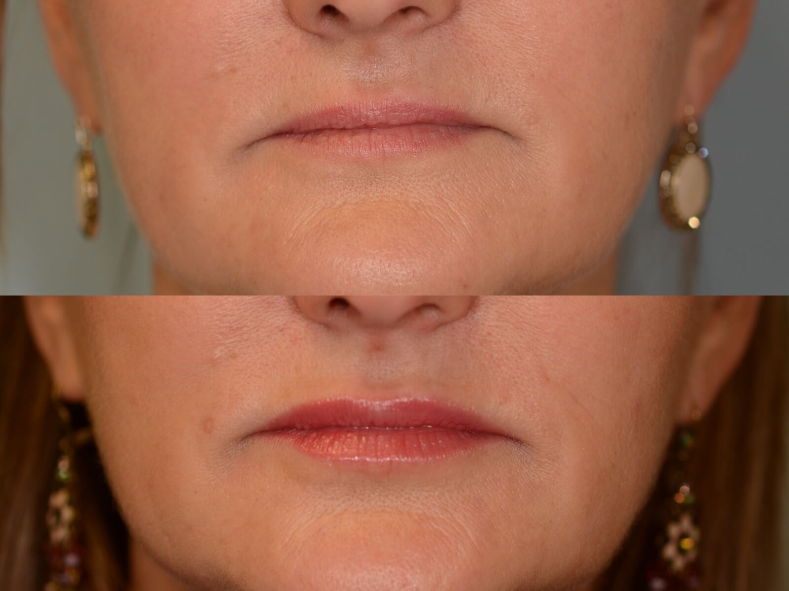 Fillers Rejuvenate the face Before and After