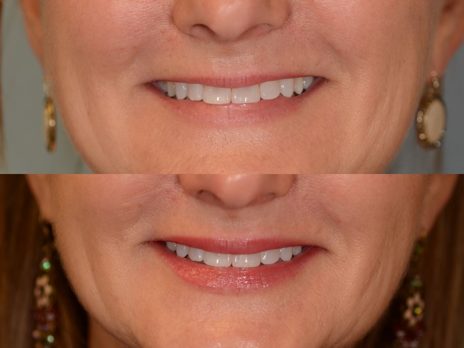 Fillers Rejuvenate the face Before and After