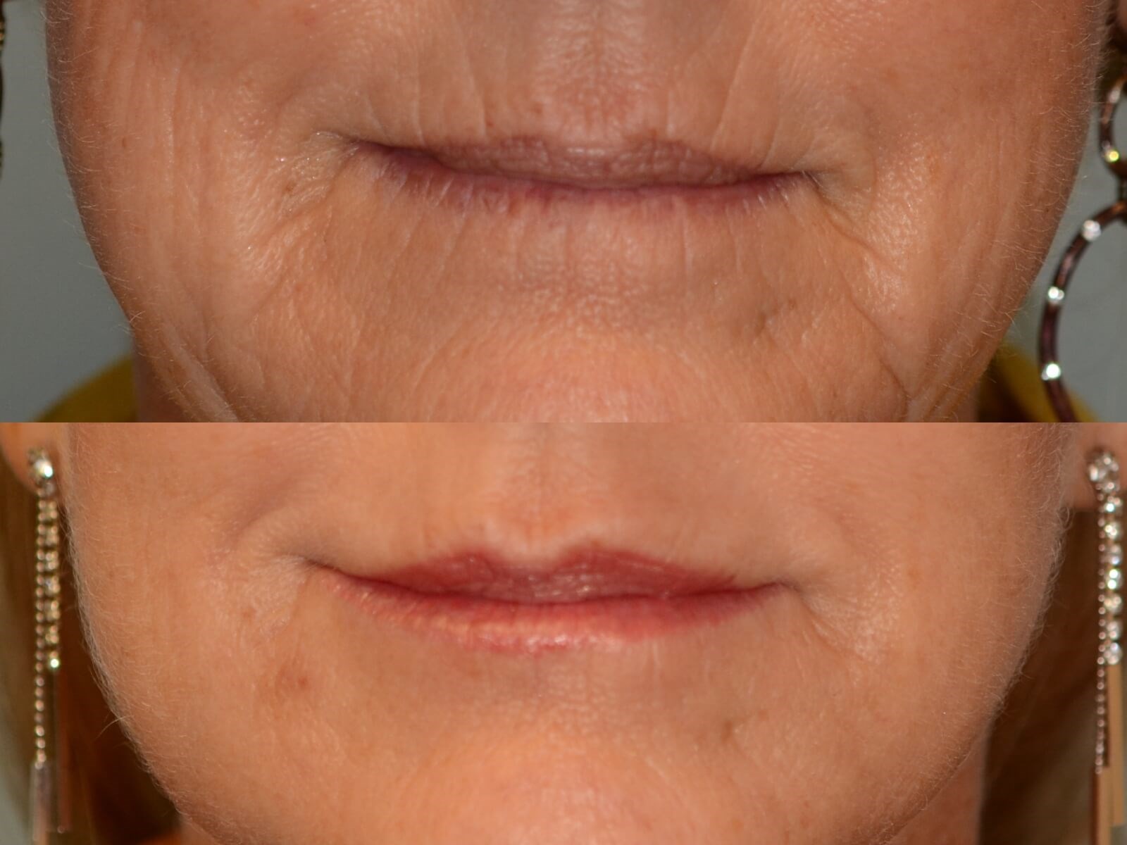 Juvederm adds lip volume! Before and After