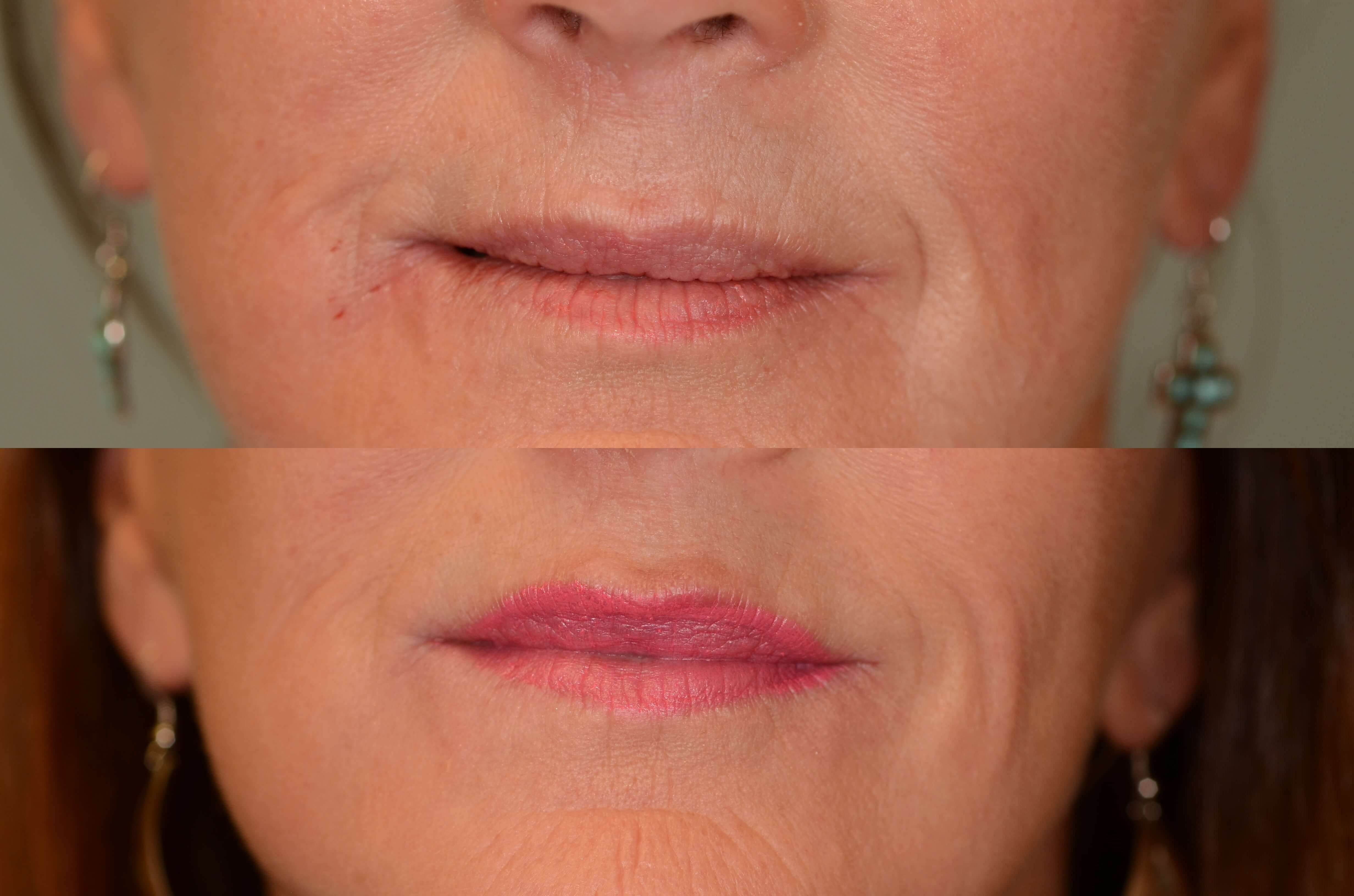 Juvederm naturally plumps lips Before and After