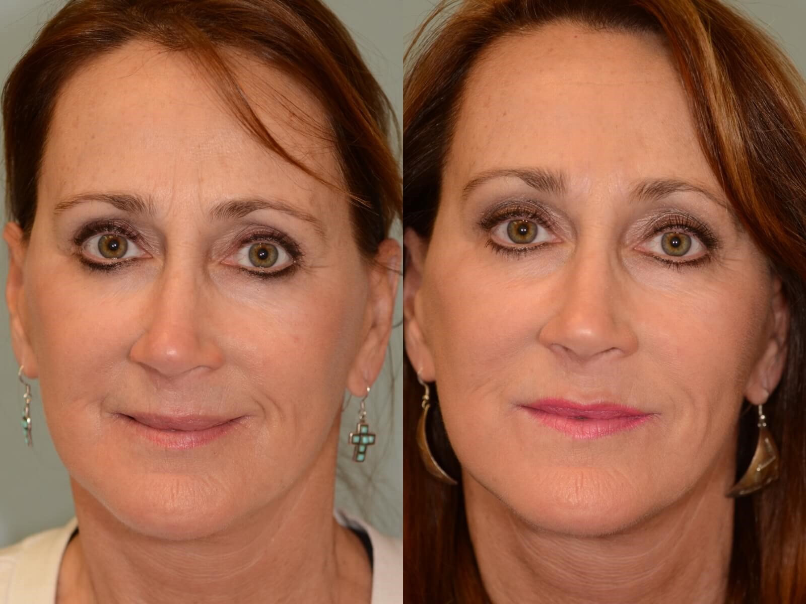 Botox for Frown Lines Before and After