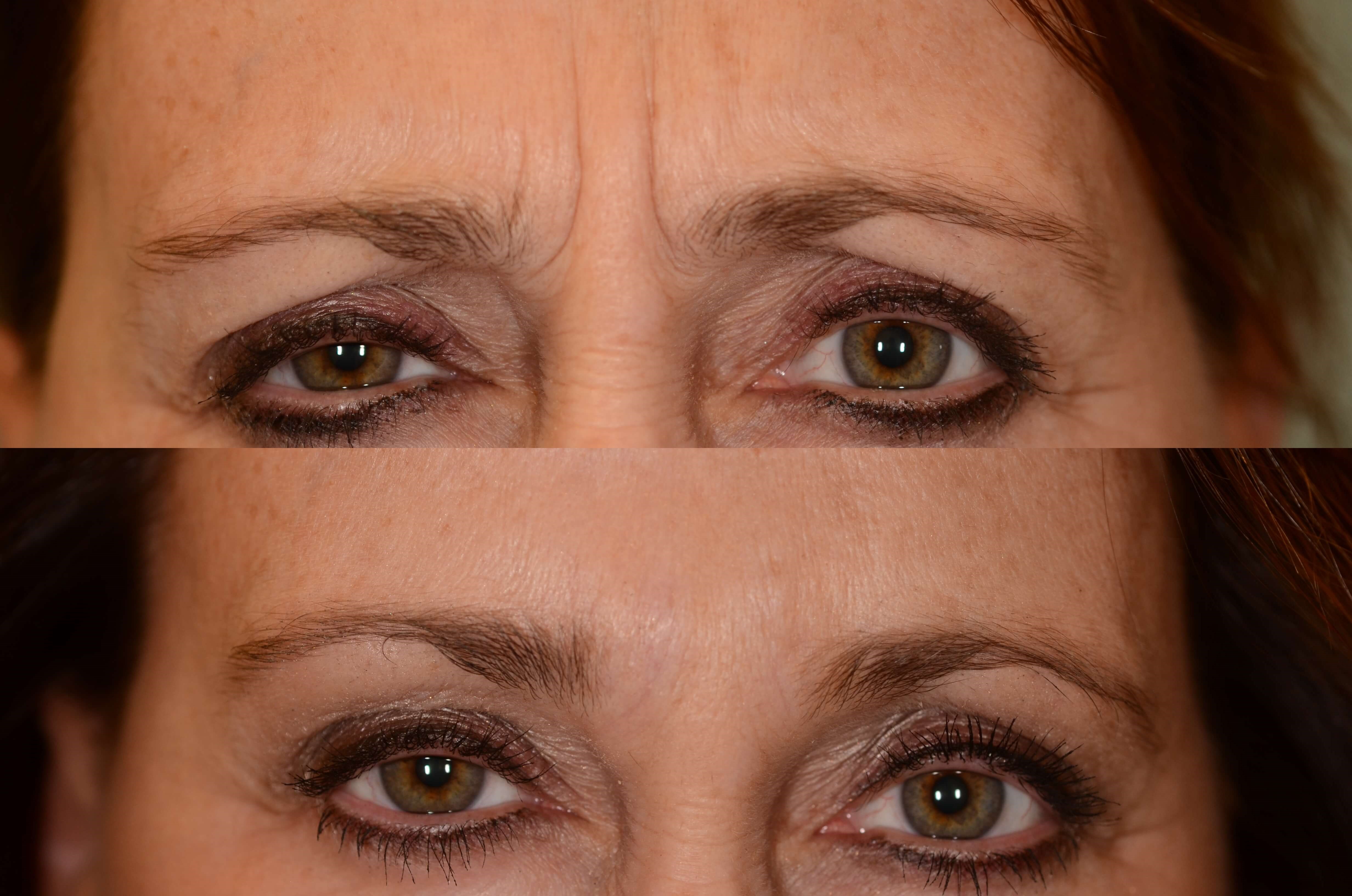 Botox for Frown Lines Before and After
