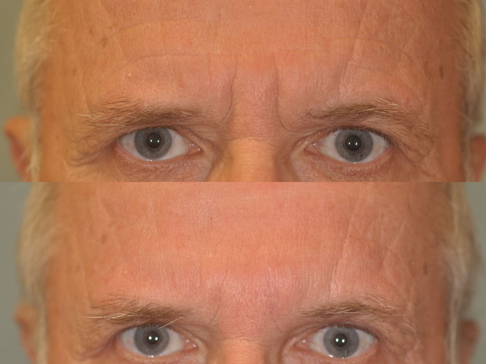 Before and After BOTOX® Cosmetic Photos