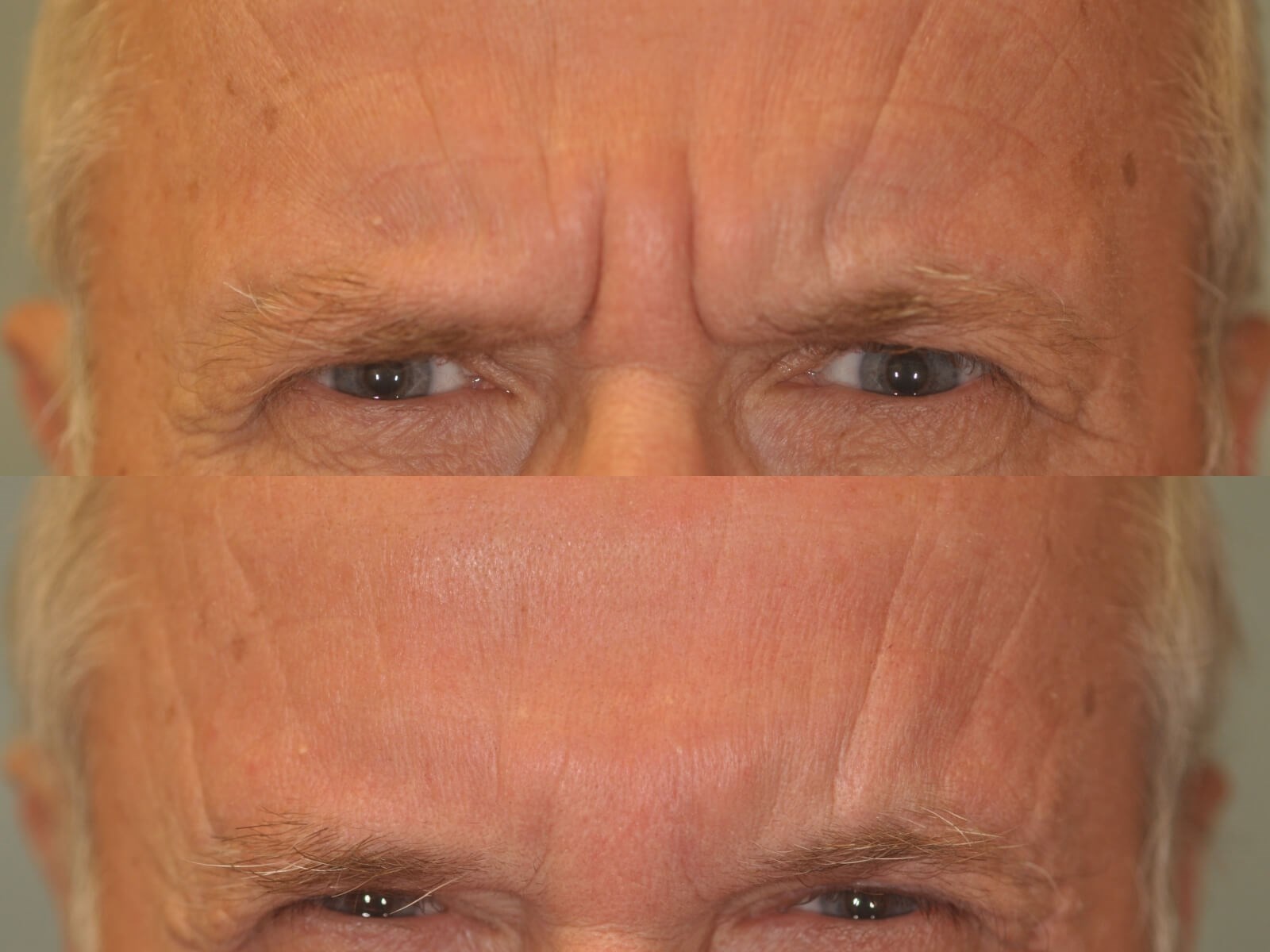 Botox for severe Frown Lines Before and After