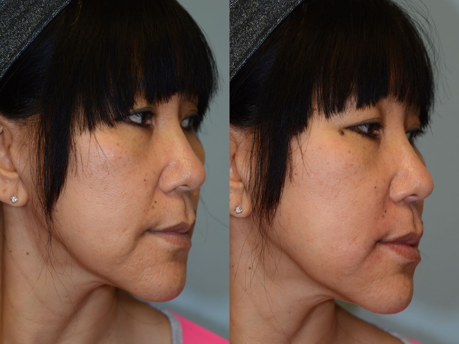 Juvederm to smooth smile lines Before and After