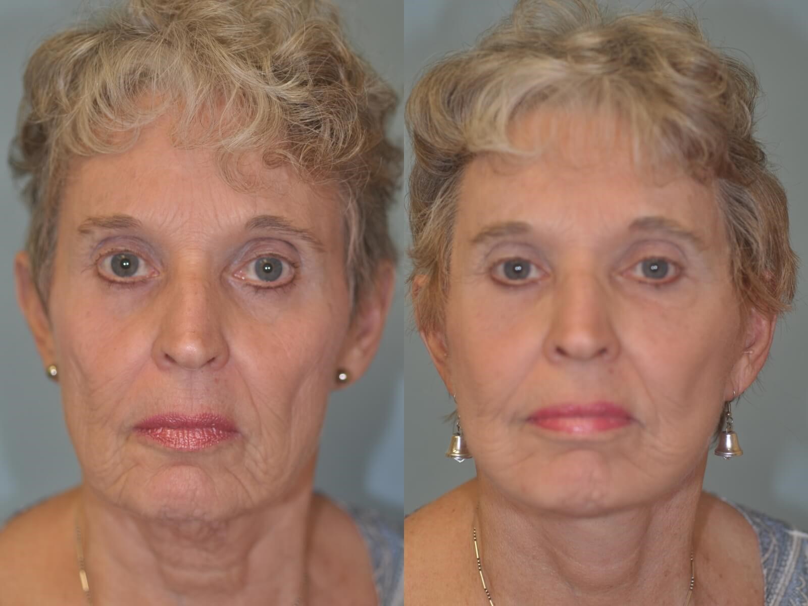 Facelift and Neck Lift Before and After