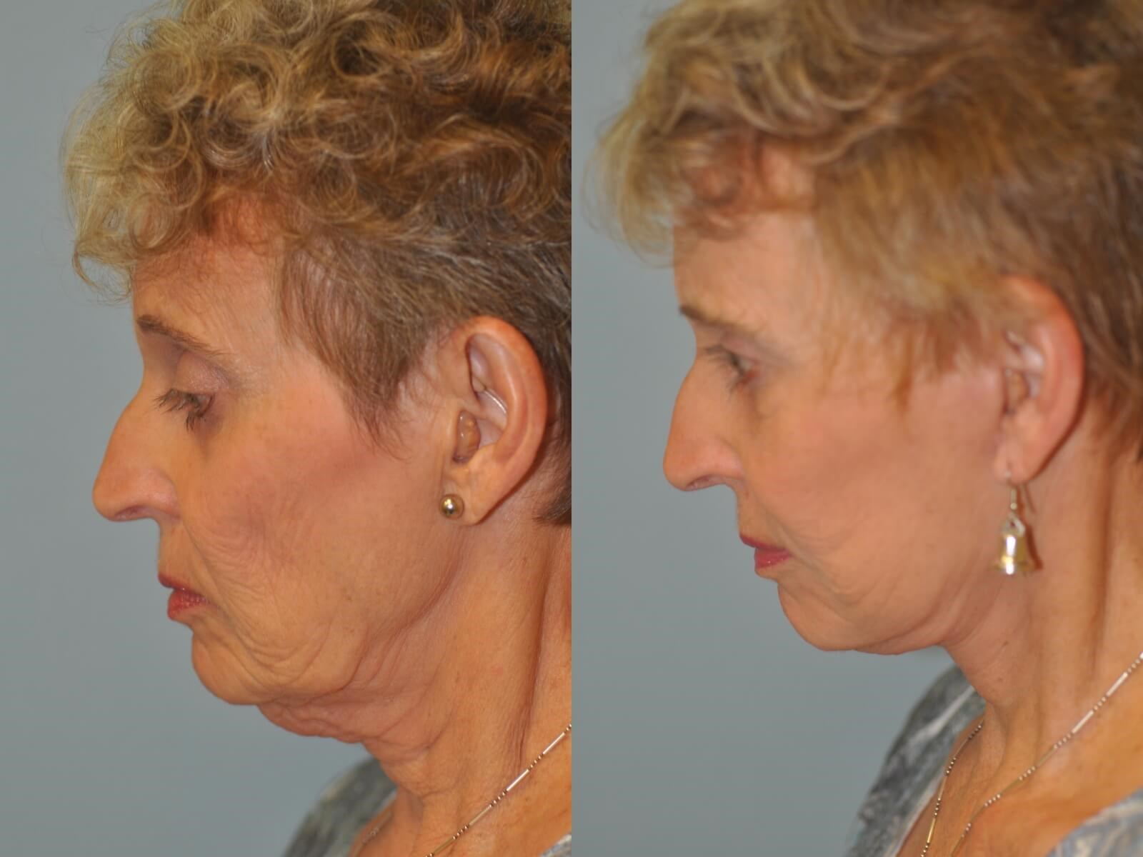 No more excess skin! Before and After