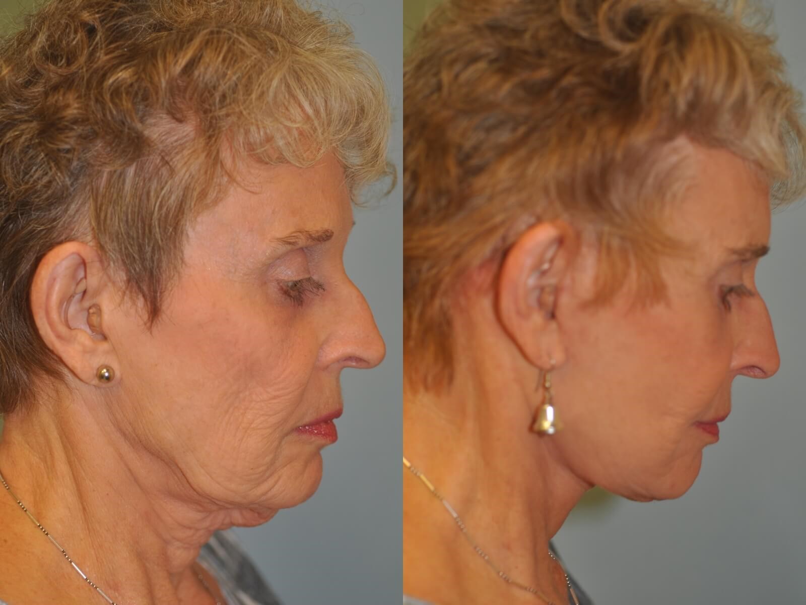 No more excess skin! Before and After
