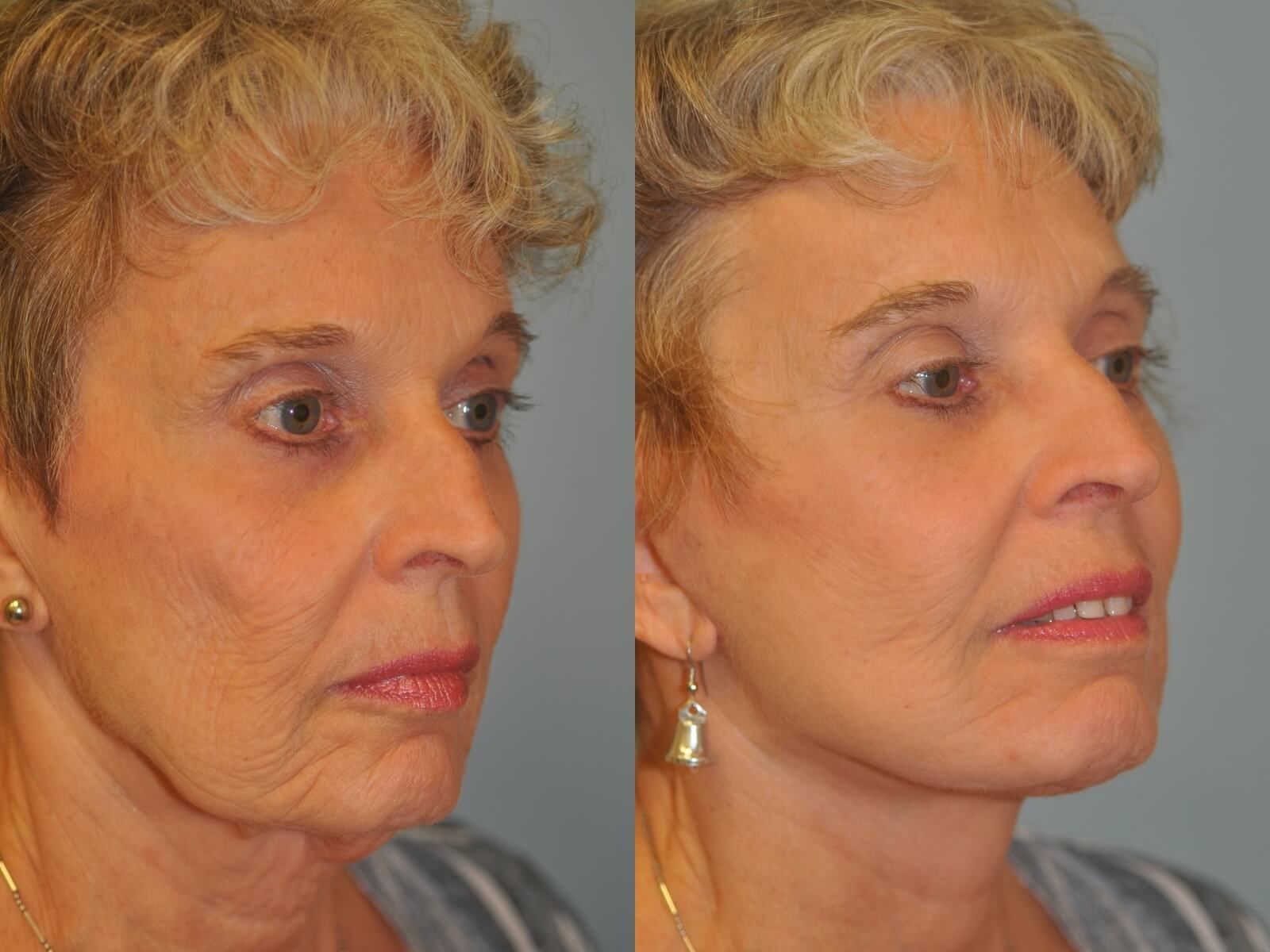 No more jowling! Before and After