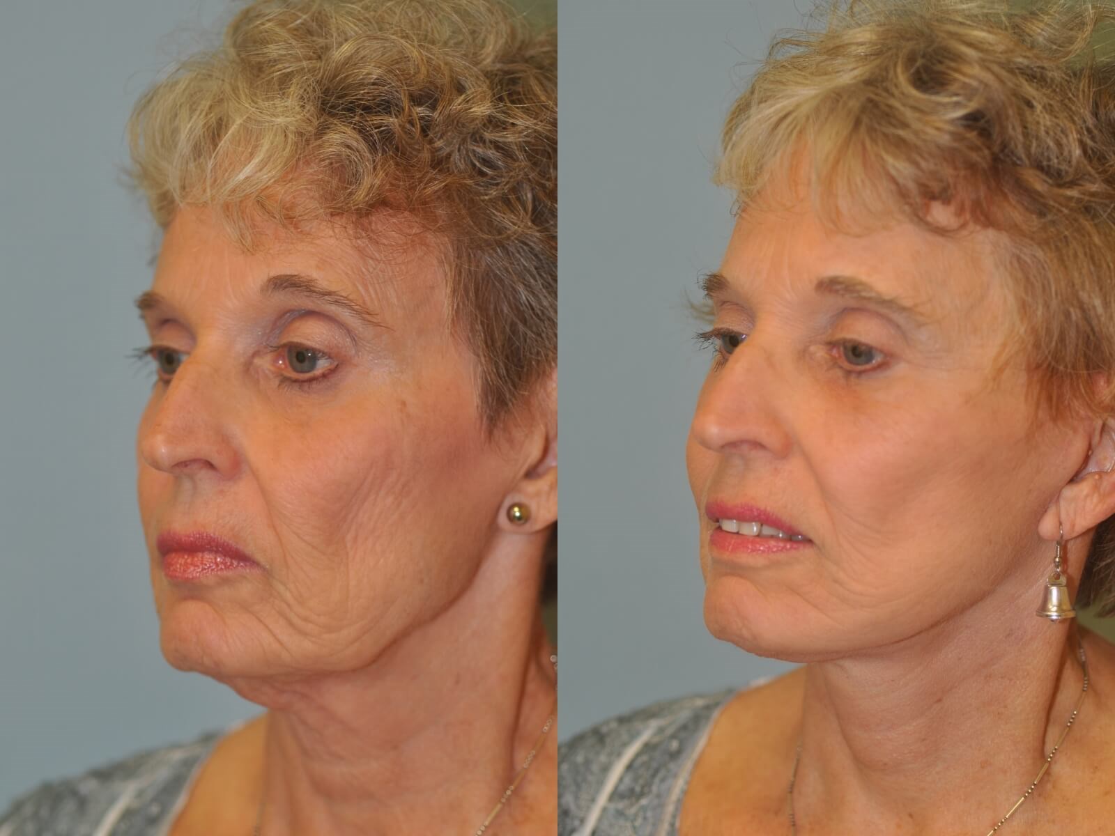 No more jowling! Before and After