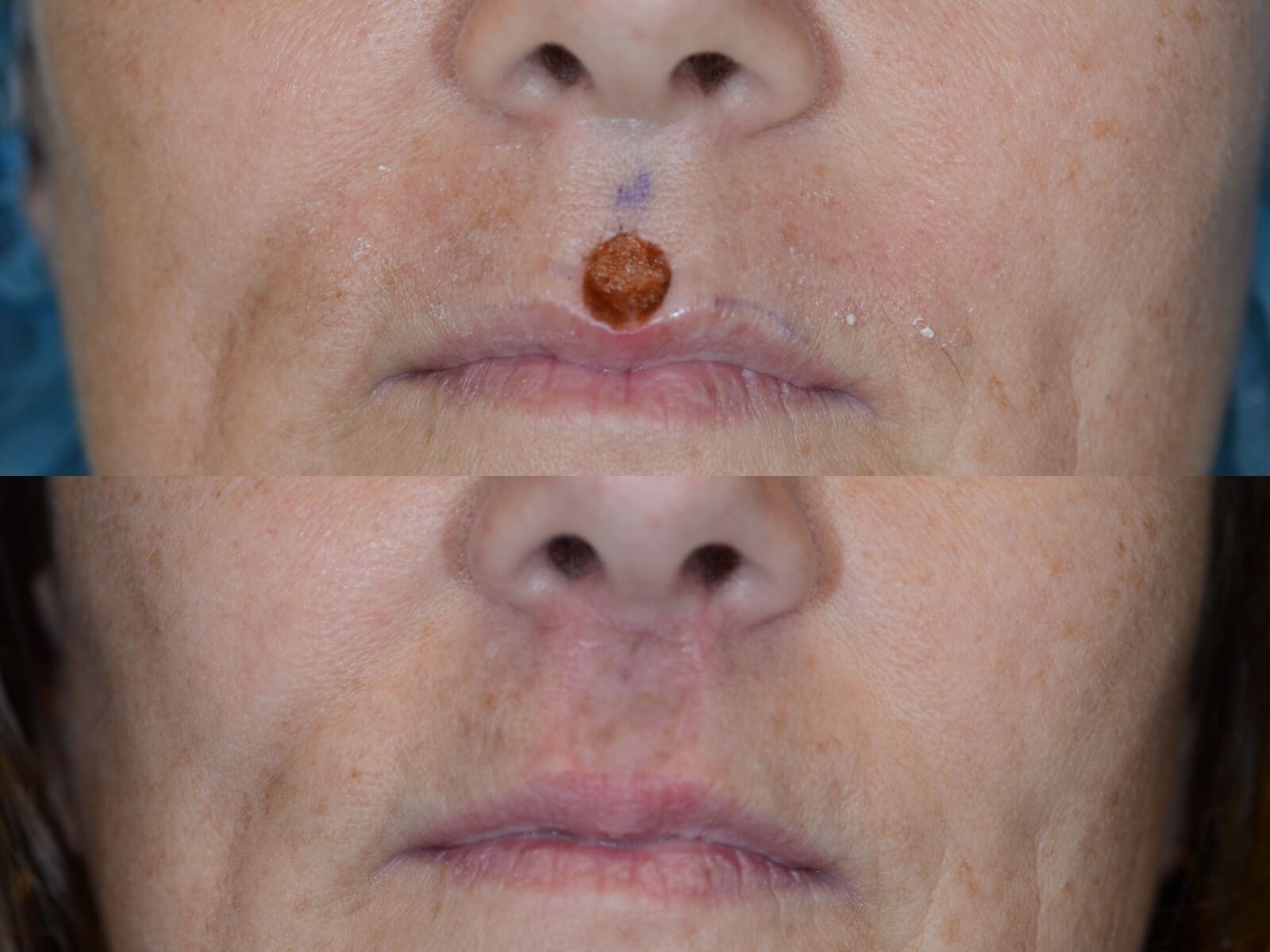 Lip reconstruction after MOHS Before and After