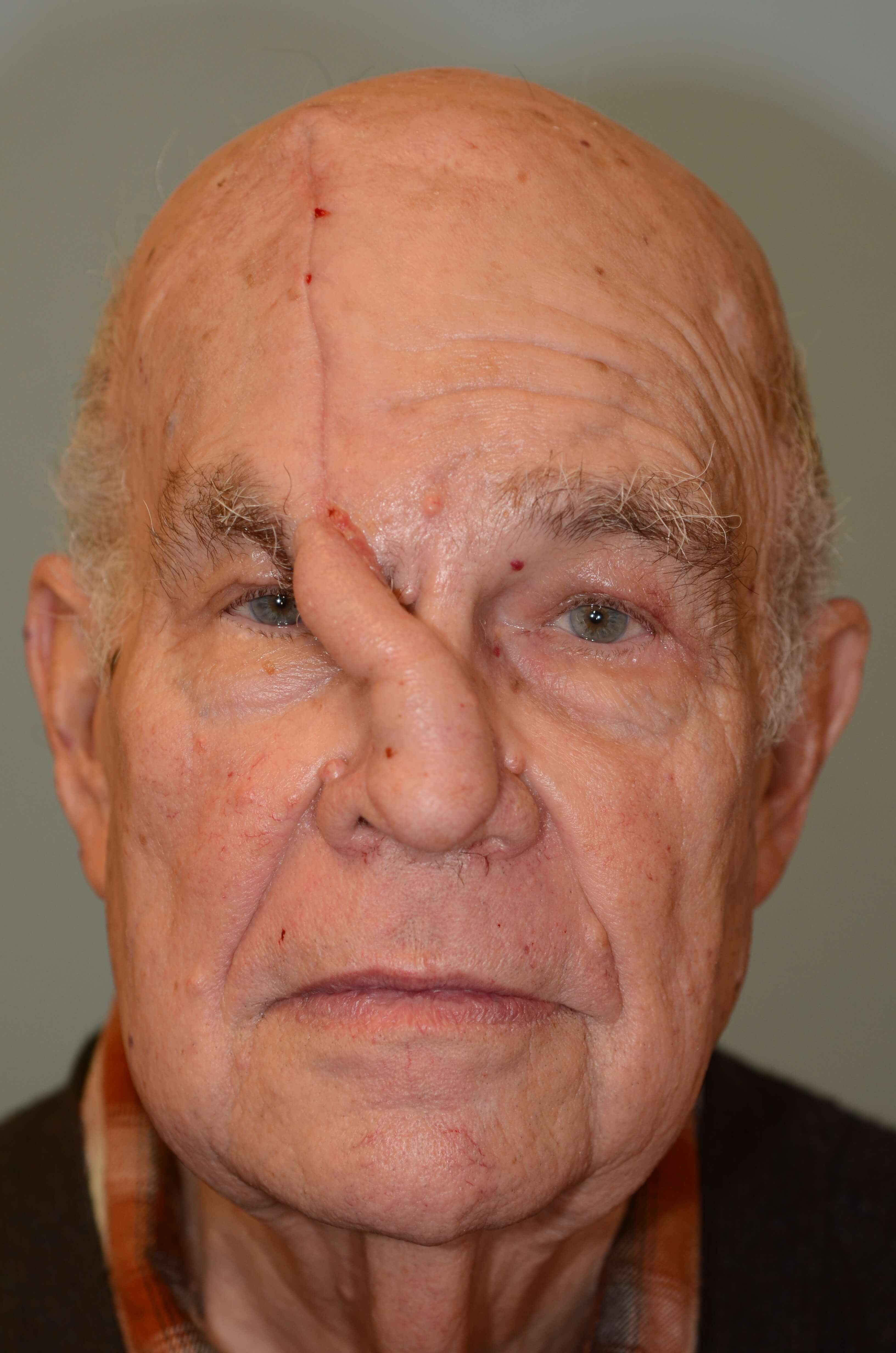 Forehead Flap Reconstruction Of Nasal Tip Following MOHs forehead-flap-reconstruction-of-nasal-tip-following-mohs