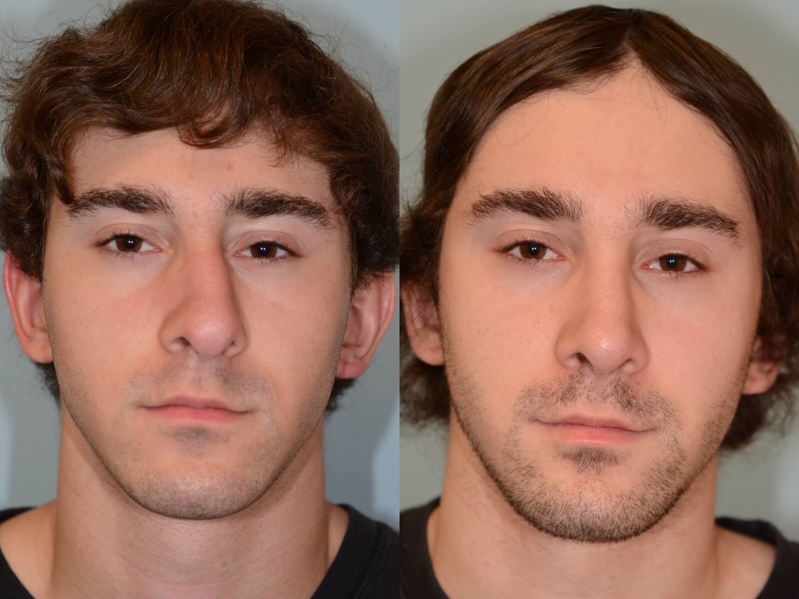 Rhinoplasty Before and  6months After