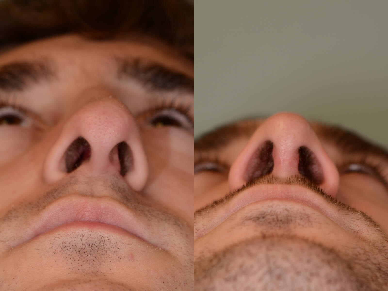 Rhinoplasty Before and After