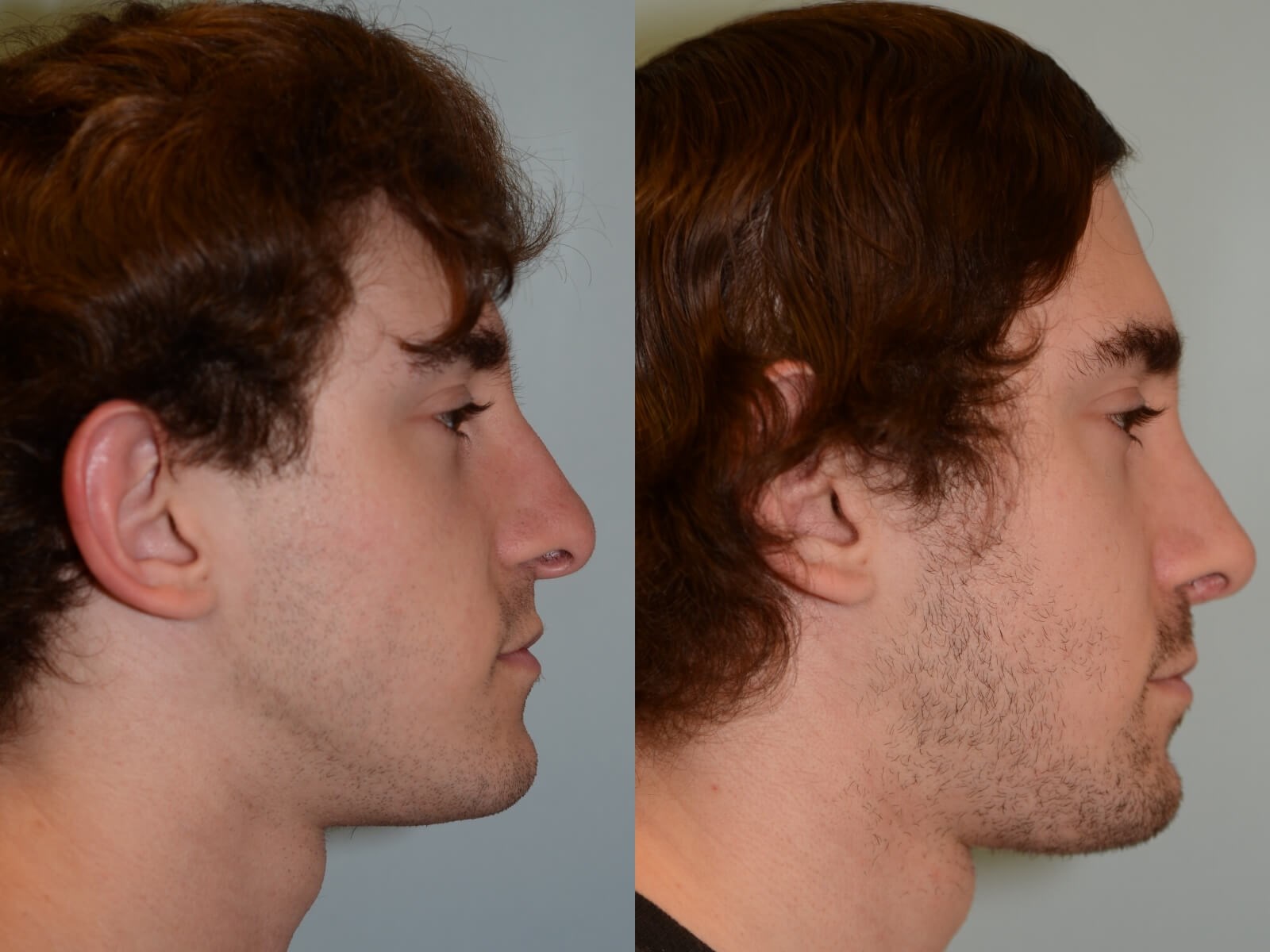 Rhinoplasty Before and After