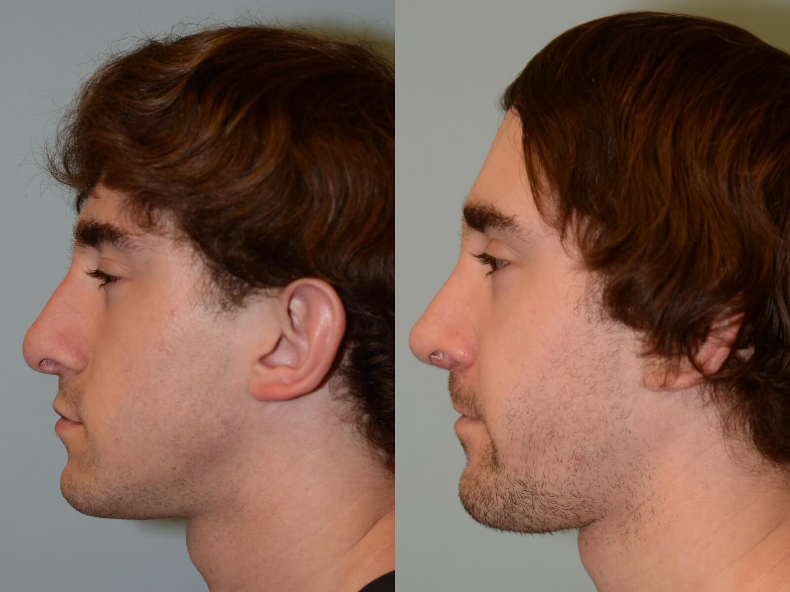 Rhinoplasty Before and After