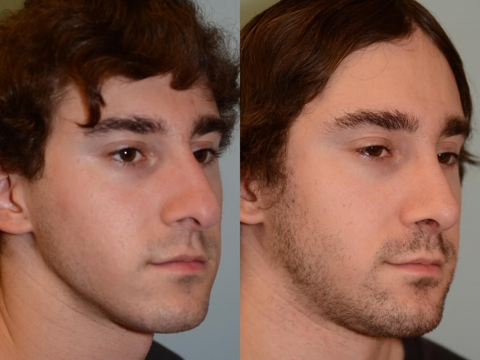 Rhinoplasty Before and After