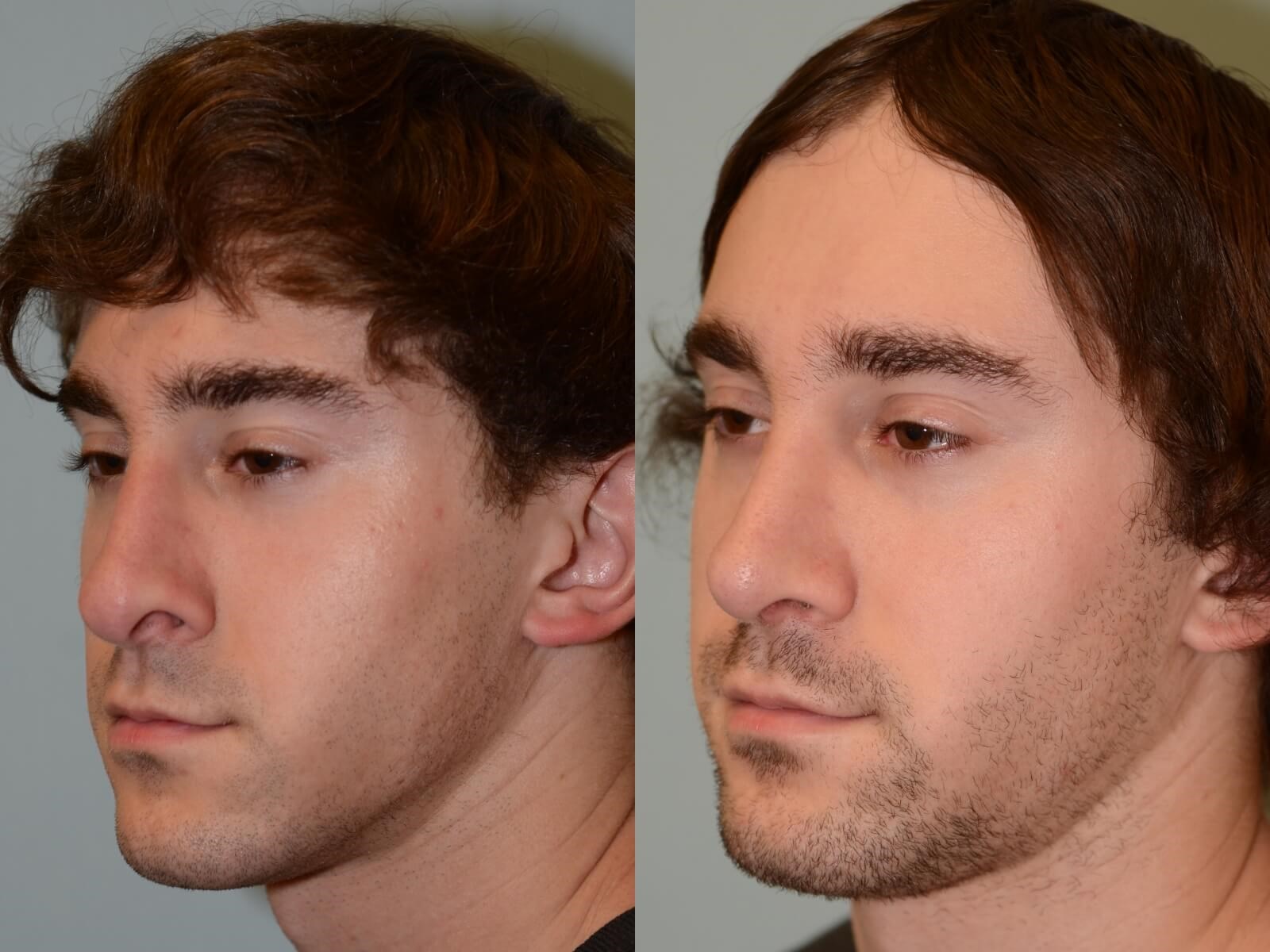 Rhinoplasty Before and After