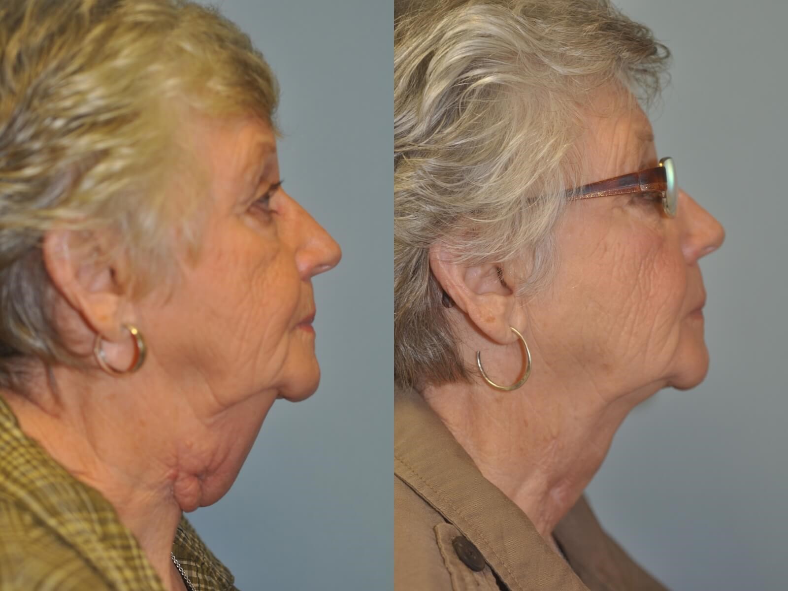 Scar Revision Before and After