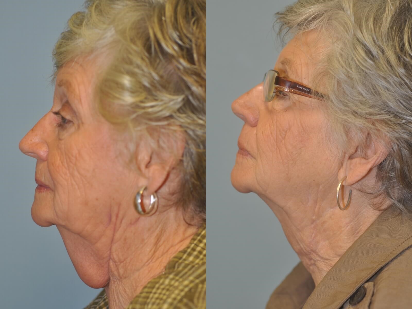 Scar Revision Before and After