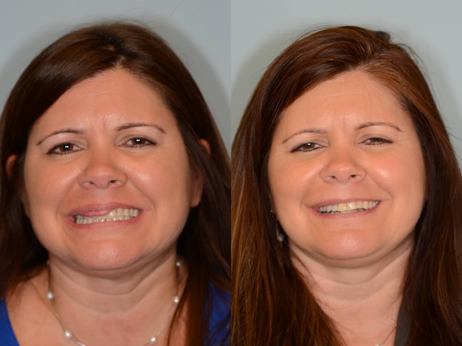 Lip Revision Before and After
