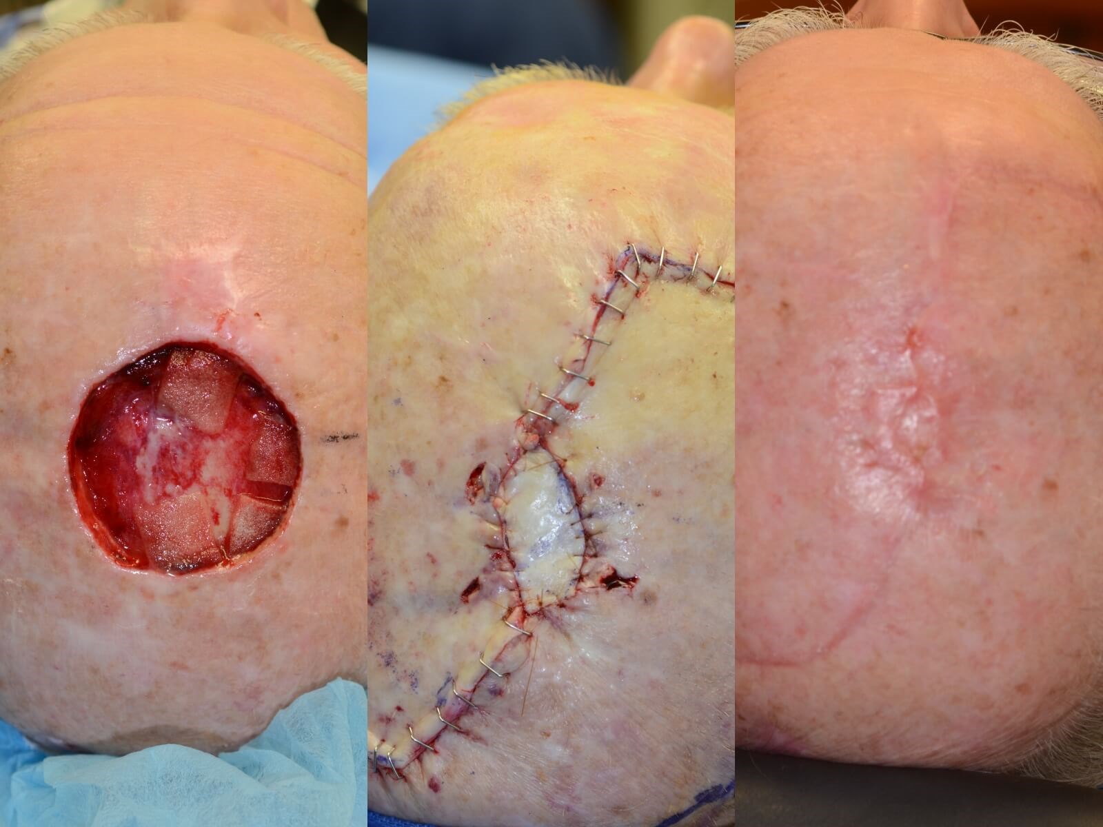 Complex Wound closure scalp Before, Post op and 3months