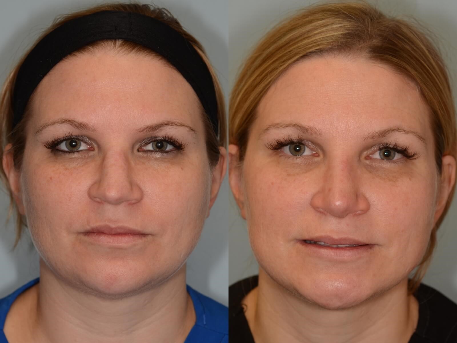 Rhinoplasty Before and After