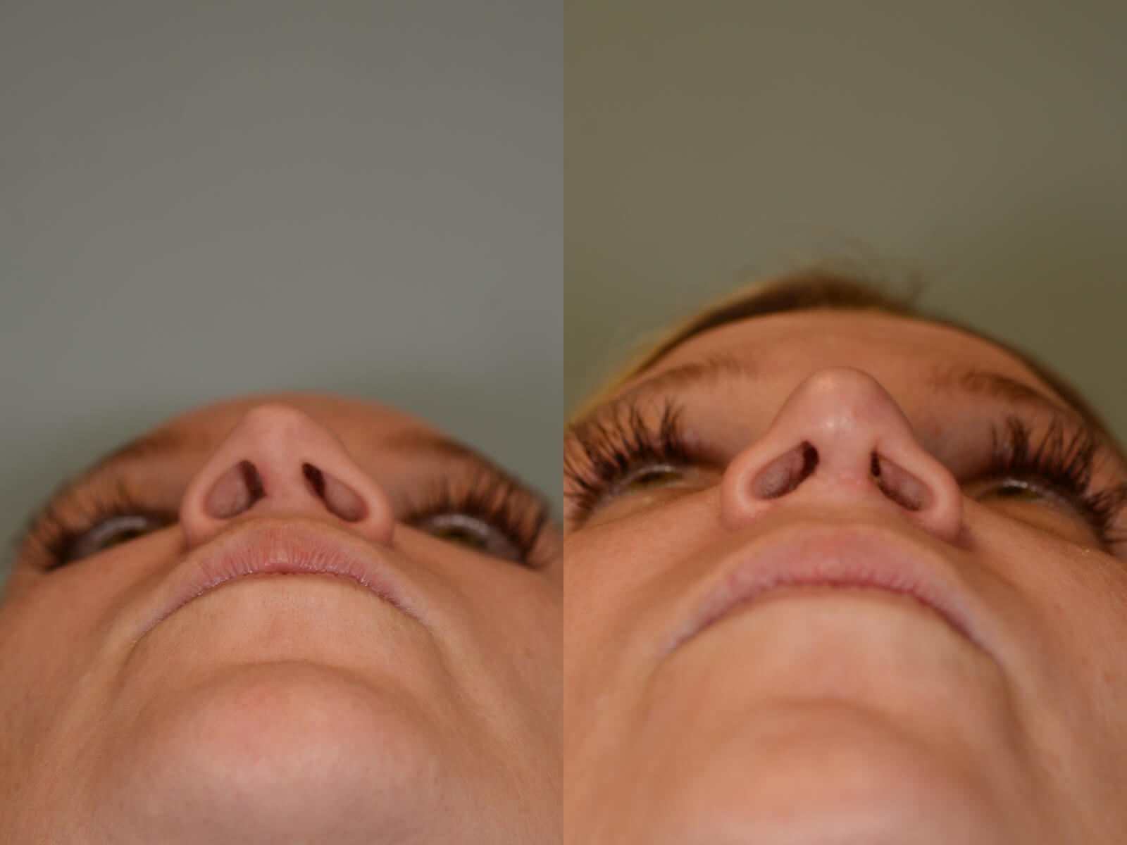 Rhinoplasty Before and After