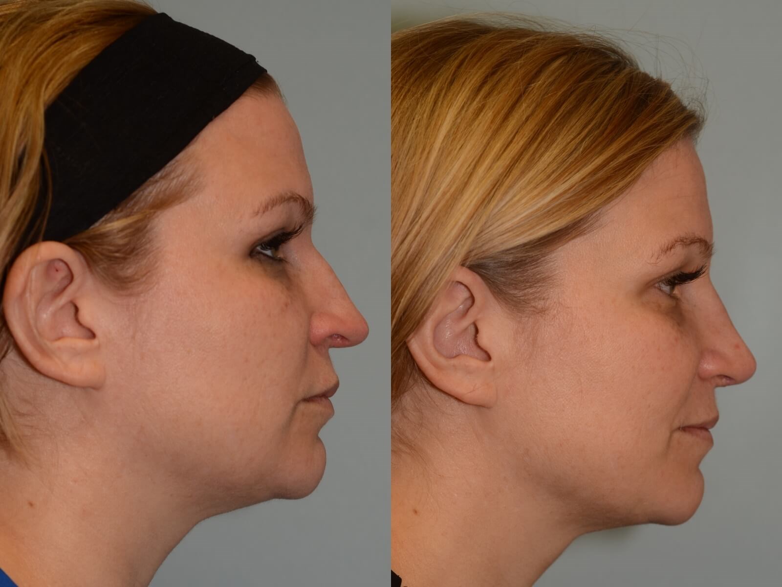 Rhinoplasty Before and After