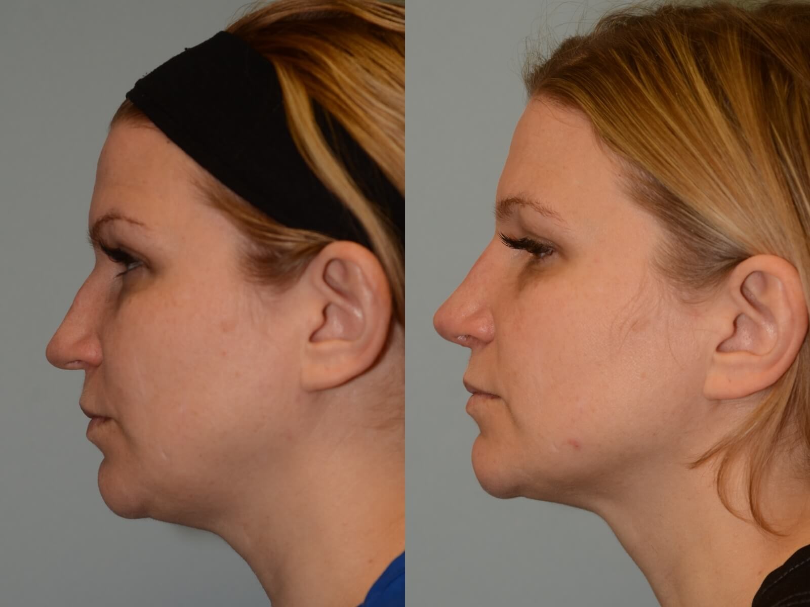 Rhinoplasty Before and After
