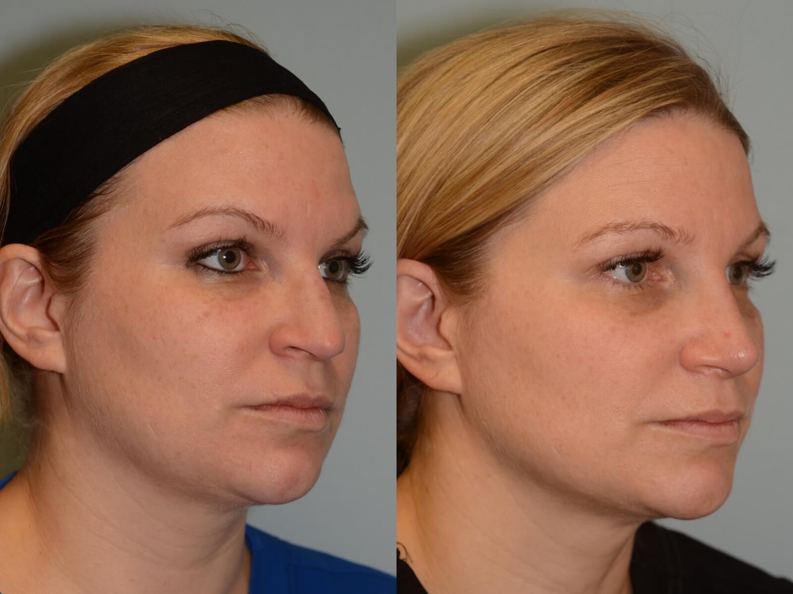 Rhinoplasty Before and After