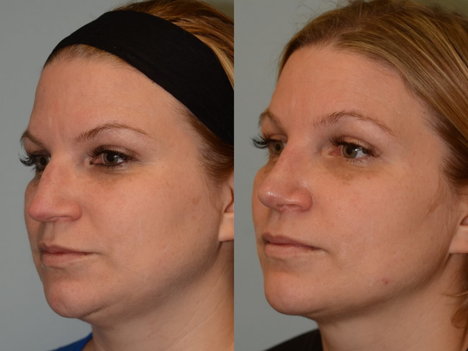 Rhinoplasty Before and After