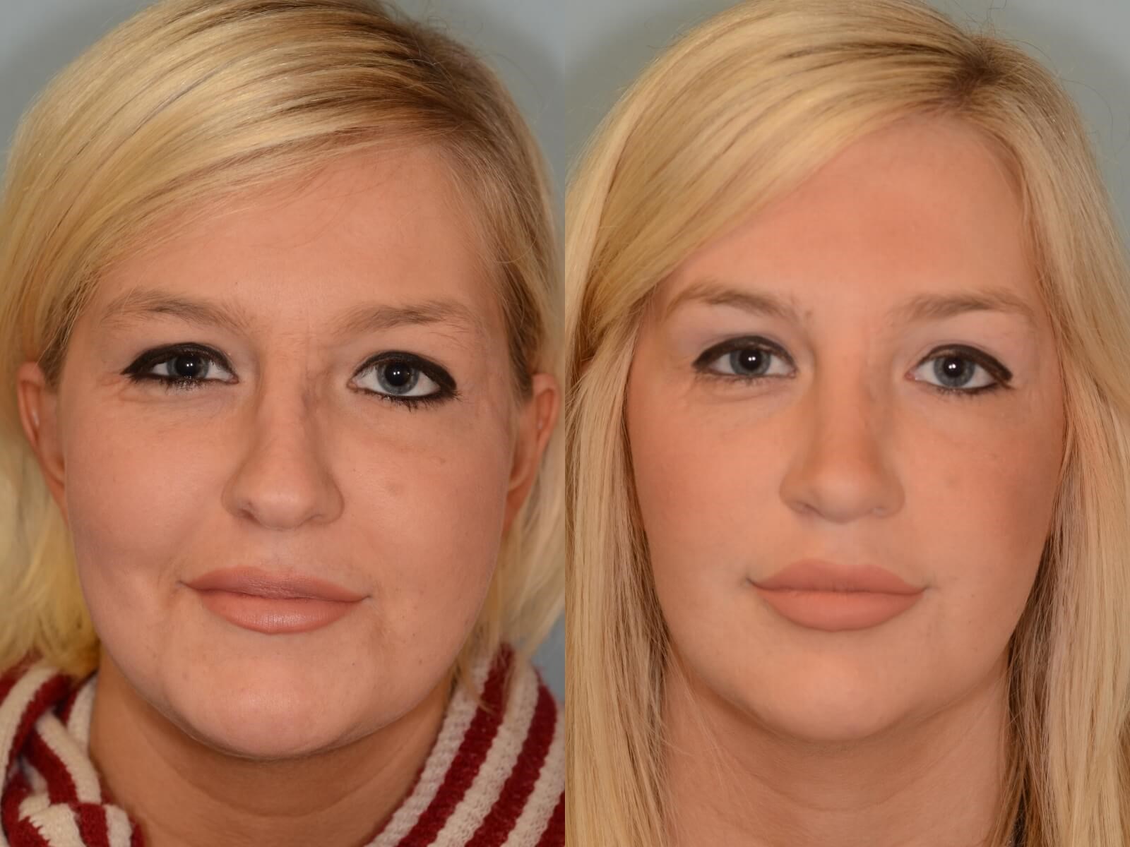 Rhinoplasty and Scar Revision Before and After