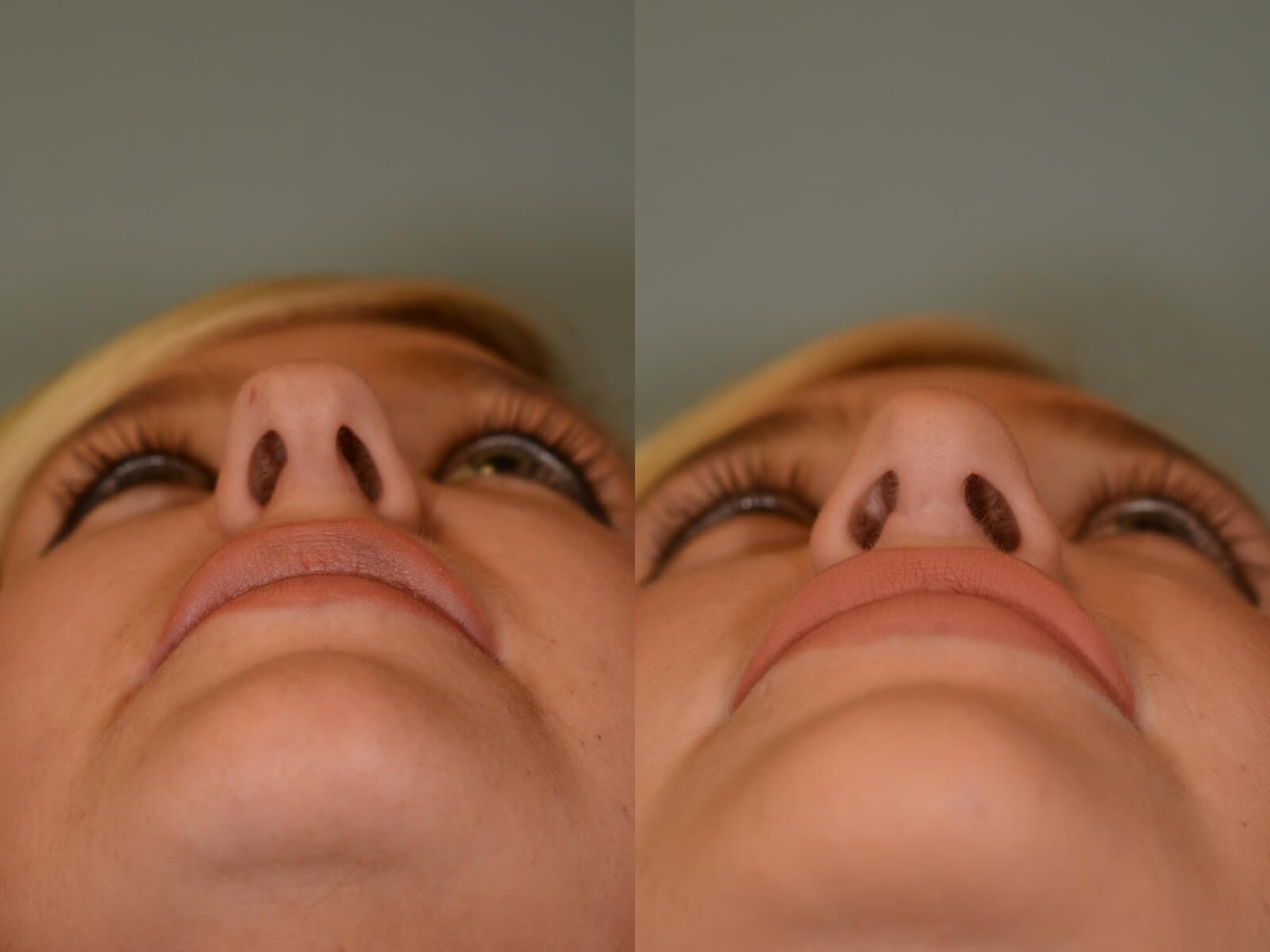 Rhinoplasty and Scar Revision Before and After