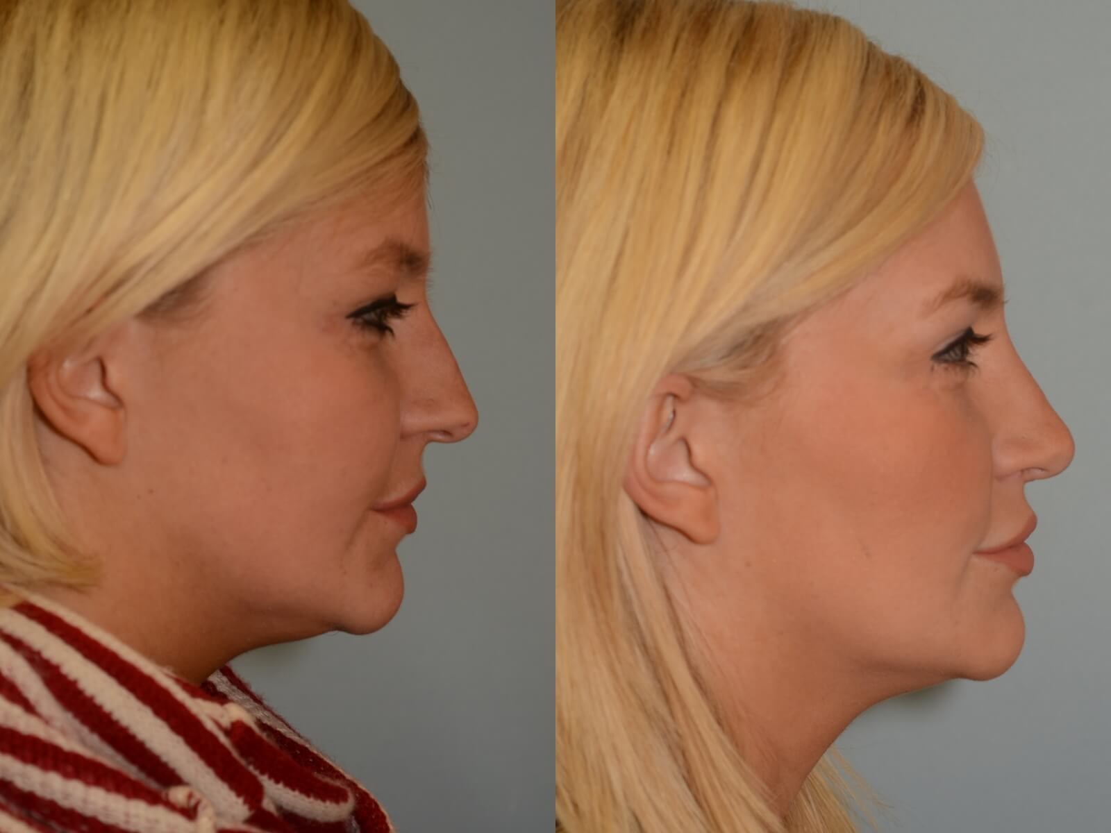 Beautiful side profile! Before and After